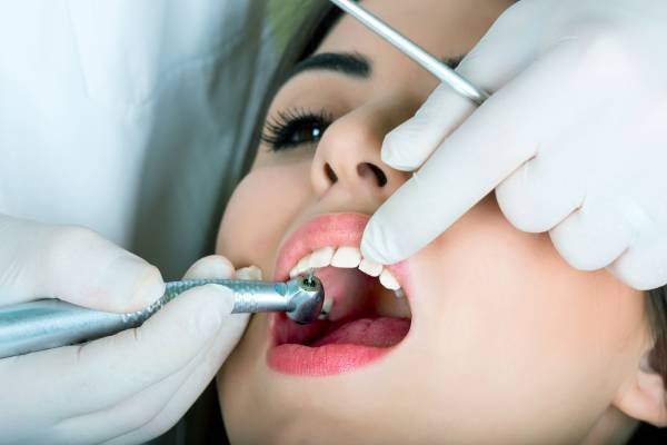 sellado dental sellado dental