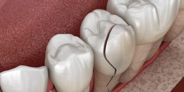fractrura diente fractura dental
