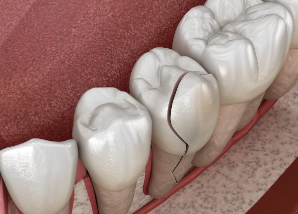 fractrura diente fractura dental