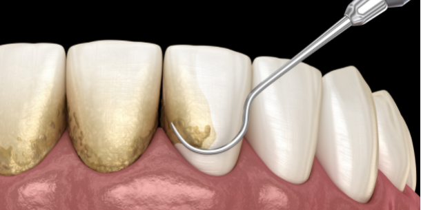 FireShot Capture 010 – Oral hygiene_ Scaling and root planing (conventional periodontal ther_ – www.canva.com