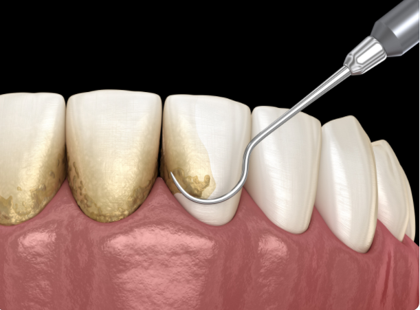 FireShot Capture 010 – Oral hygiene_ Scaling and root planing (conventional periodontal ther_ – www.canva.com