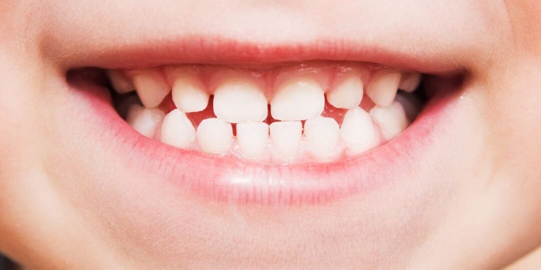 hipoplasia dental hipoplasia dental