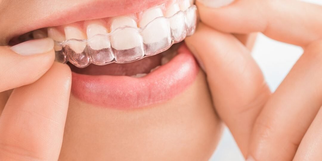 ortodoncia invisible bilbao ortodoncia invisible bilbao