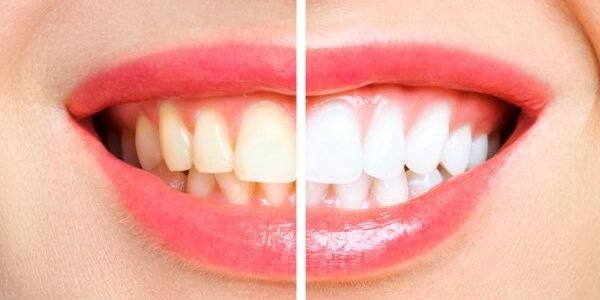 blanqueamiento dental en bilbao blanqueamiento dental en bilbao